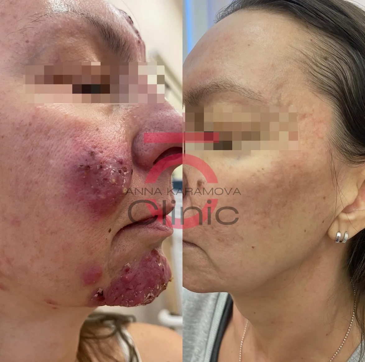 Пациент 41 лет — фото до и после, ракурс 2